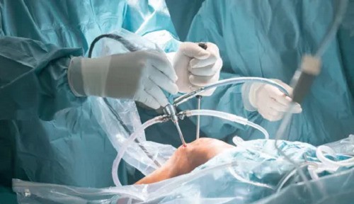 What Is the Average Settlement for Faulty Knee Replacement?